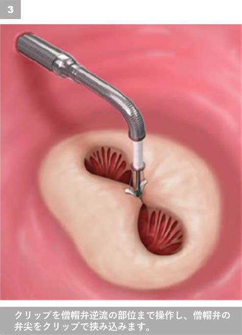 Mitraclip－経皮的僧帽弁接合不全修復術｜心臓血管センター｜横浜市立大学附属市民総合医療センター