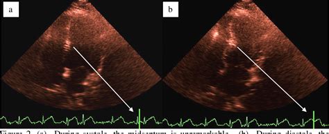 Figure From Dynamic Interventricular Septal Hematoma Following Blunt