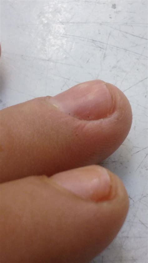 What Causes The Bumpsdivots On My Fingernails They Have Been An Issue