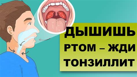 ХРОНИЧЕСКИЙ ТОНЗИЛЛИТ: как заложенность носа усугубляет болезнь - YouTube