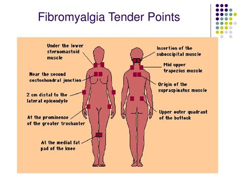 Ppt Soft Tissue Rheumatism Powerpoint Presentation Free Download