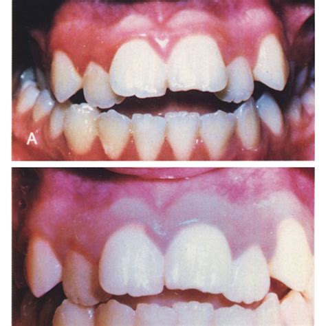 Patient at age 13 years, before and after rapid palatal expansion with ...