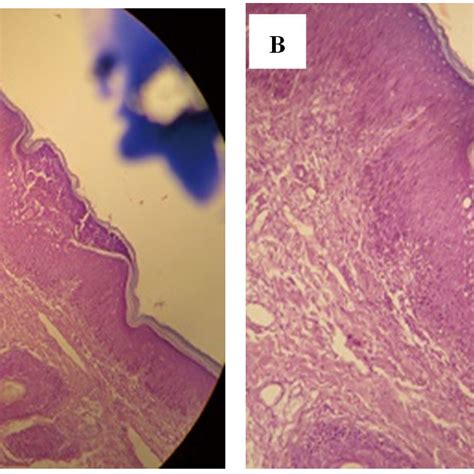 Clinical Finding A B Erythematous Nodules C Fragile Pustules On