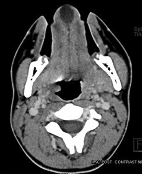 Intralingual Mucous Extravasation Cyst An Uncommon Lingual Cyst