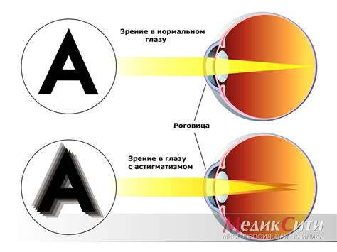Астигматизм: причины и лечение. Коррекция астигматизма