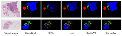 Automatic Segmentation Of Breast Cancer Histological Images Based On