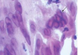 Pathology Of Vulva Vagina Flashcards Quizlet