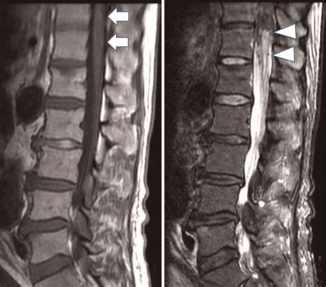 Spinal Cord Infarction Is Identified On Mri A T1wi Arrow B T2wi