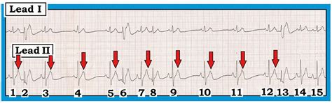 Ecg Interpretation Ecg Interpretation Review 78 Pacs Atrial