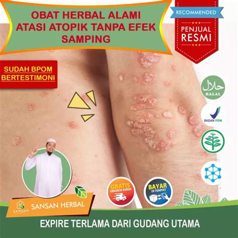 Detail Gambar Penyakit Dermatitis Atopik Koleksi Nomer 47