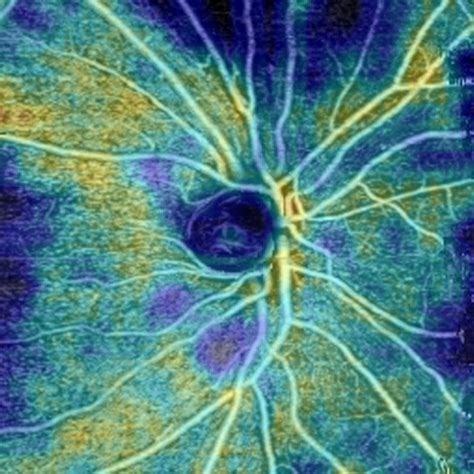 L Oct Angiographie Imagerie D Taill E De La R Tine Nidek France