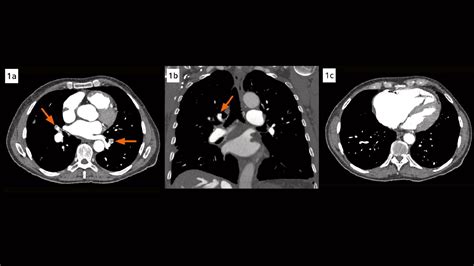 chronic thromboembolic pulmonary hypertension diagnosed  covid
