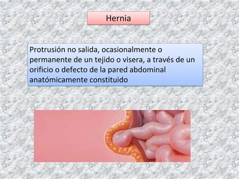 Hernias Inguinales Clasificación Y Tratamientopptx