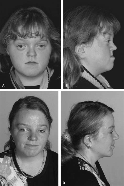 Pfeiffer Syndrome Treatment