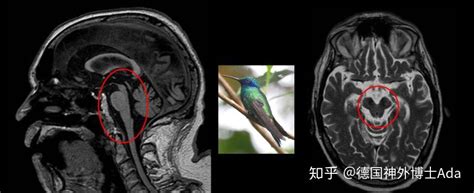 影像图谱｜帕金森病和帕金森综合征的影像 知乎