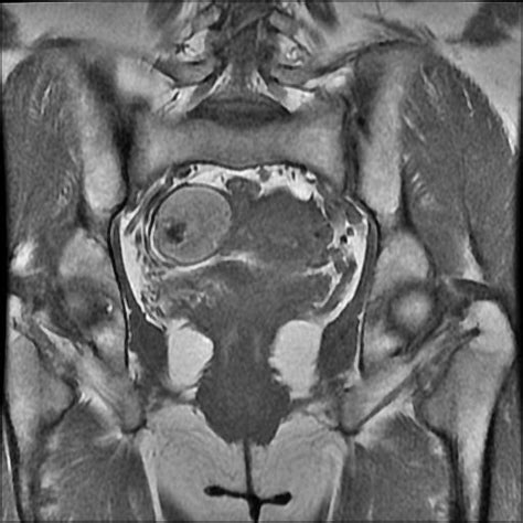 Bilateral Ovarian Dermoid Cysts Image