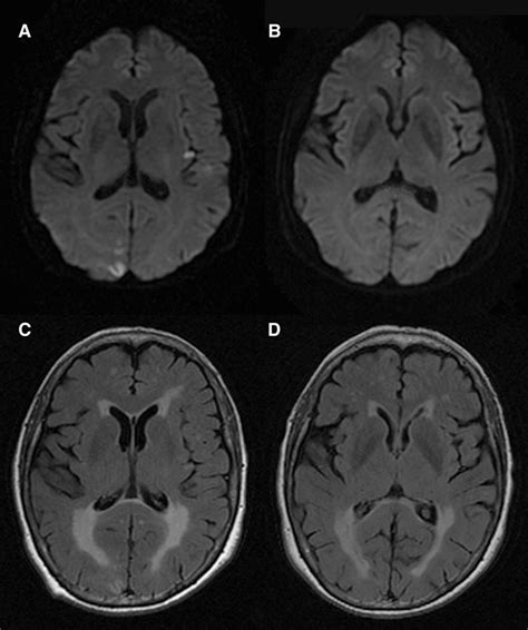 Early Magnetic Resonance Imaging in Transient Ischemic Attack and Minor ...