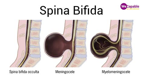 Spina Bifida Spinal Cord