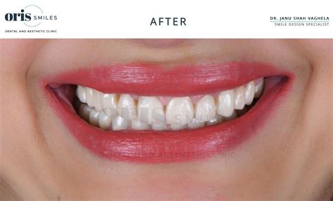 Dental Clinic In Ahmedabad Cosmetic Dentistry Oris Smiles