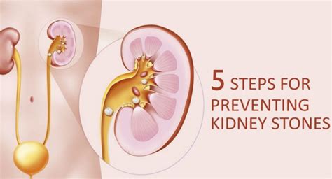 5 Steps for Preventing Kidney Stones | Virinchi Hospitals, Hyderabad
