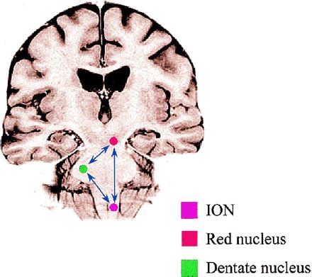 Hypertrophic Olivary Degeneration Metaanalysis Of The Temporal