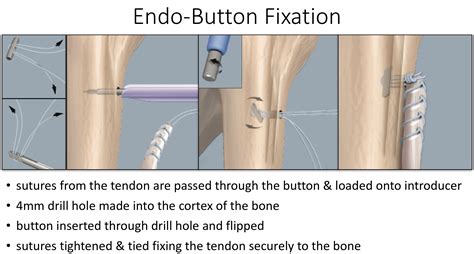 Arthroscopic Surgery Cambridge Shoulder