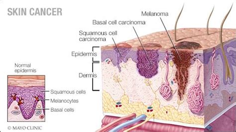 Living With Cancer Understanding Squamous Cell Carcinoma Mayo Clinic