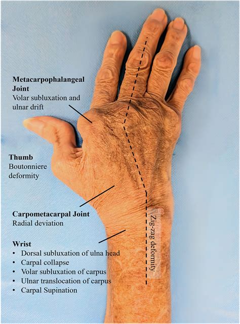 Assessment Of Progressive Hand And Wrist Deformities In The Rheumatoid