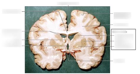 Coronal Cut Of Cadaver Brain Diagram Quizlet