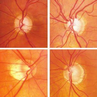 (PDF) Clinical Optic Disc Evaluation in Glaucoma