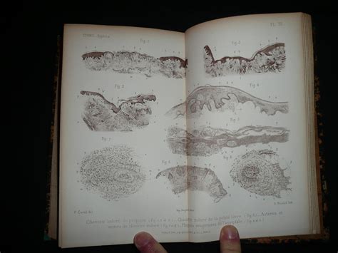 Leçons Sur La Syphilis Faites à Lhôpital De Lourcine 1879 Edition