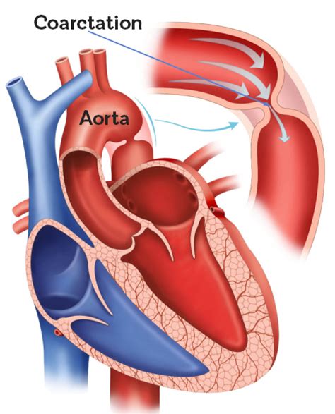 Coarctation Of The Aorta Bhf