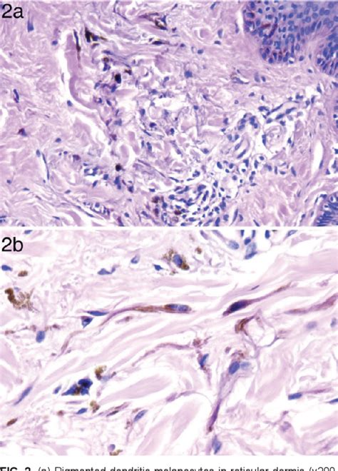 Figure 2 From Dermoscopic Findings Of Nevus Of Ota Semantic Scholar