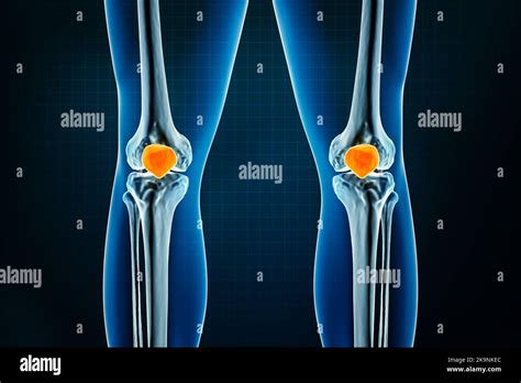 Patella Or Kneecap Bone X Ray Front Or Anterior View Osteology Of The