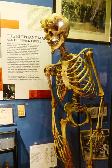 John Merrick Skull