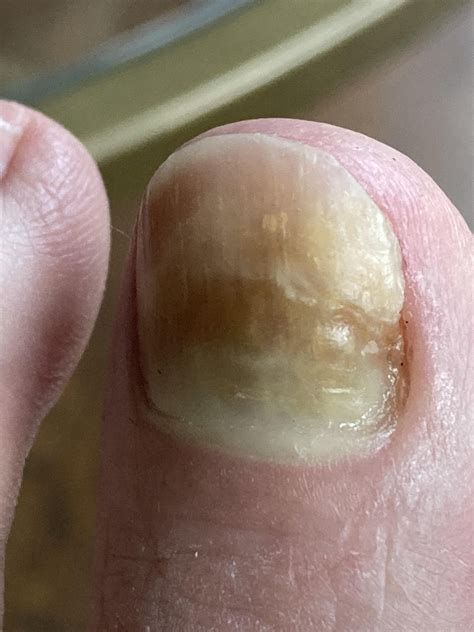 Hi I Have Toenail Fungus Which Is Heeling Is This Spot On My Finger