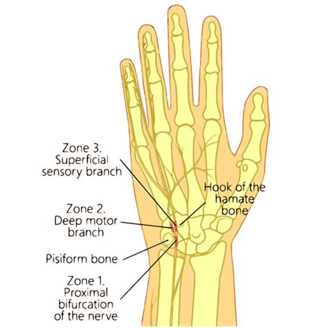 Sindrome Del Canale Di Guyon Fisiatria Interventistica