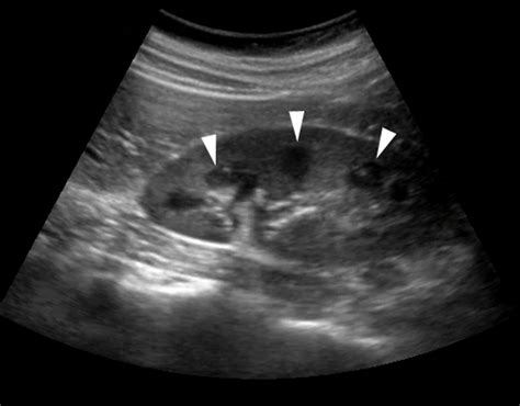 Renal Images | Emergency Ultrasonography