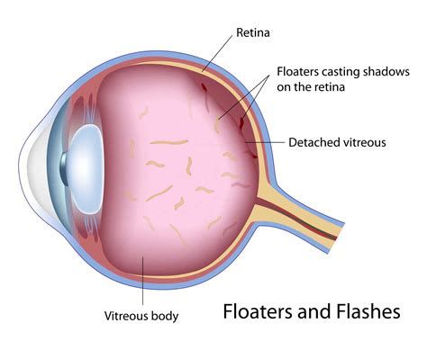 Vitreous Eye Floaters & Retinal Detachment – Petrou Eye Care