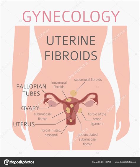 Uterine Fibroids Ginecological Medical Desease Women Infographic Vector