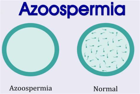 What Is Azoospermia Symptoms Causes And Treatment Sunrise Ivf