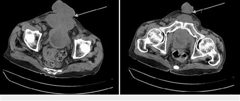 Figure 2 From Adenocarcinoma Of Urinary Bladder With Distant Metastasis