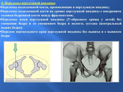 Физическая реабилитация при переломах костей таза