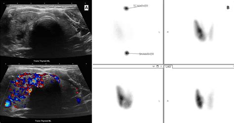 A Thyroid Ultrasound Performed At The Time Of Diagnosis B Thyroid