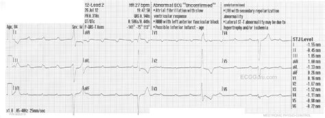 Complete Heart Block | ECG Guru - Instructor Resources