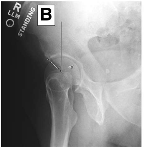 Pdf Outside In Capsulotomy Of The Hip For Arthroscopic Pincer Resection