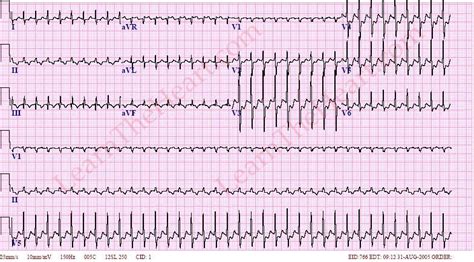 Atrioventricular Nodal Reentry Tachycardia Avnrt Ecg Example 3