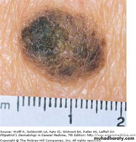 Skin tumors pptx - D. Alaa - Muhadharaty