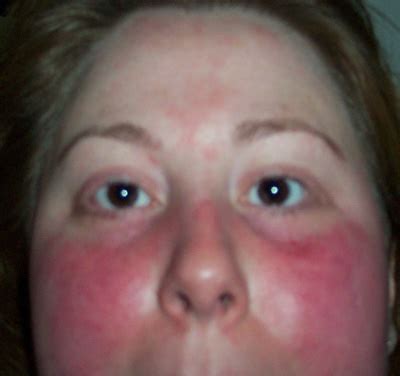 Malar Rash (Butterfly Rash) - Pictures, Causes, Diagnosis and Treatment