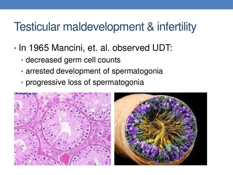 Cryptorchidism Undescended Testes